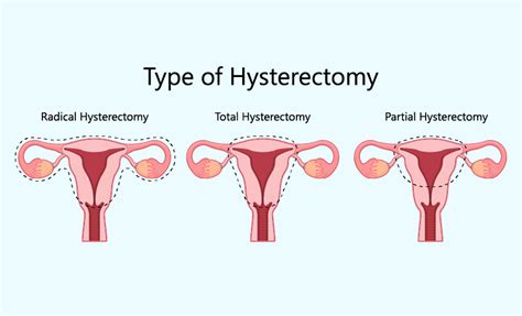 Hysterectomy in Chesterfield: top 10 doctors .